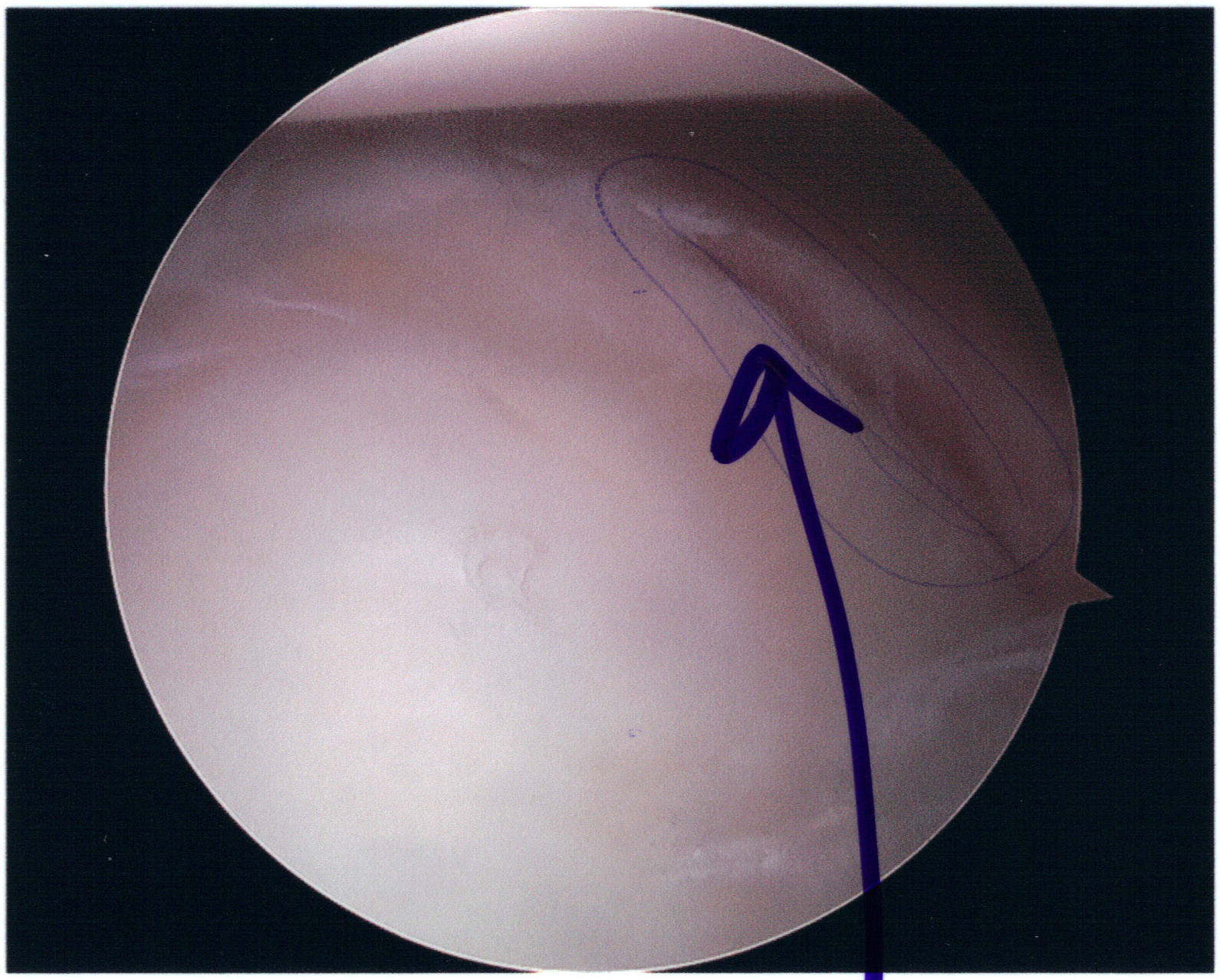 Arthroscopic view of a Bankart lesion of the anteroinferior glenoid labrum