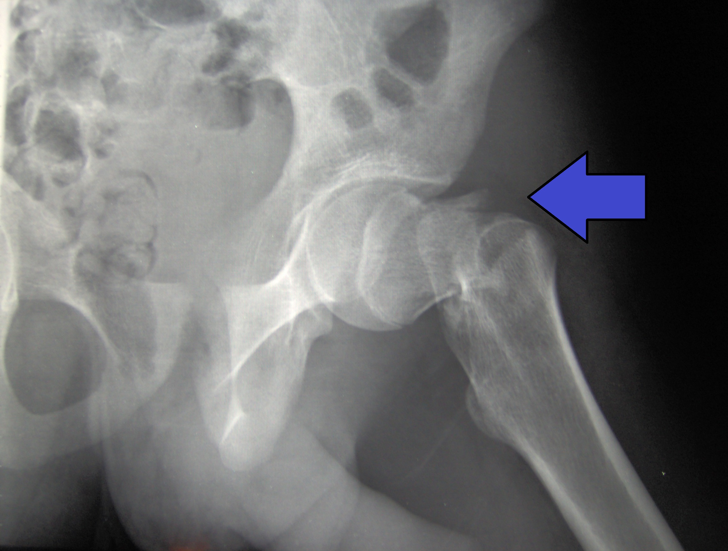 Pelvis X-ray showing a proximal-femur (intertrochanteric-type) fracture