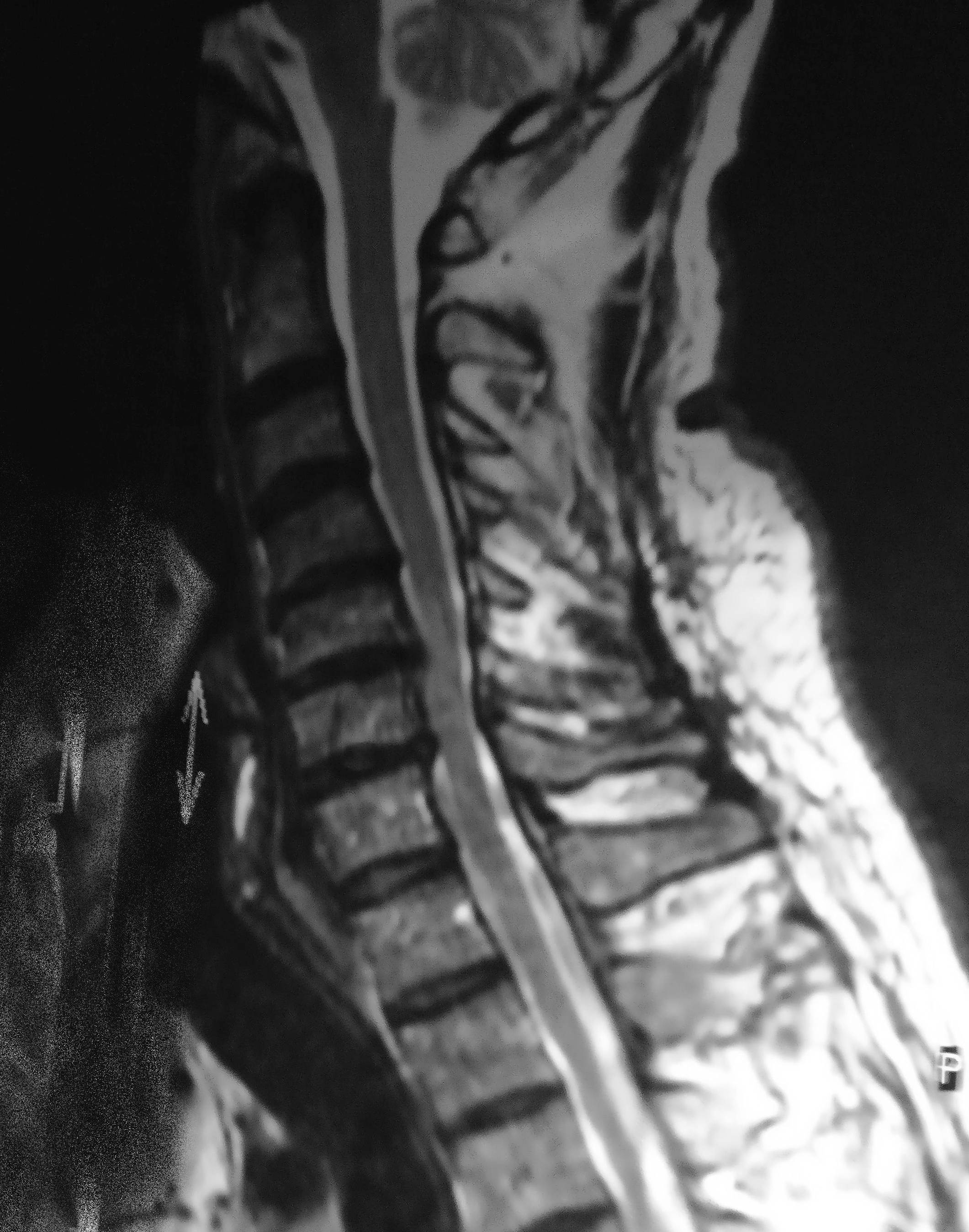 MRI showing cervical spinal stenosis with cord compression