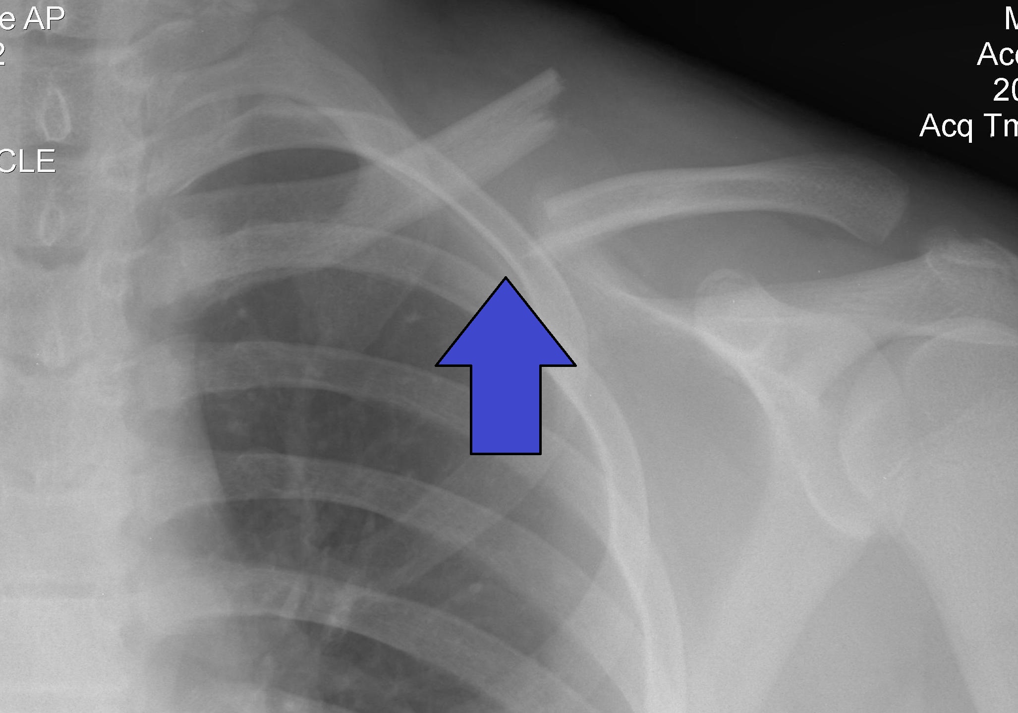 Chest X-ray showing a displaced mid-shaft left clavicle fracture
