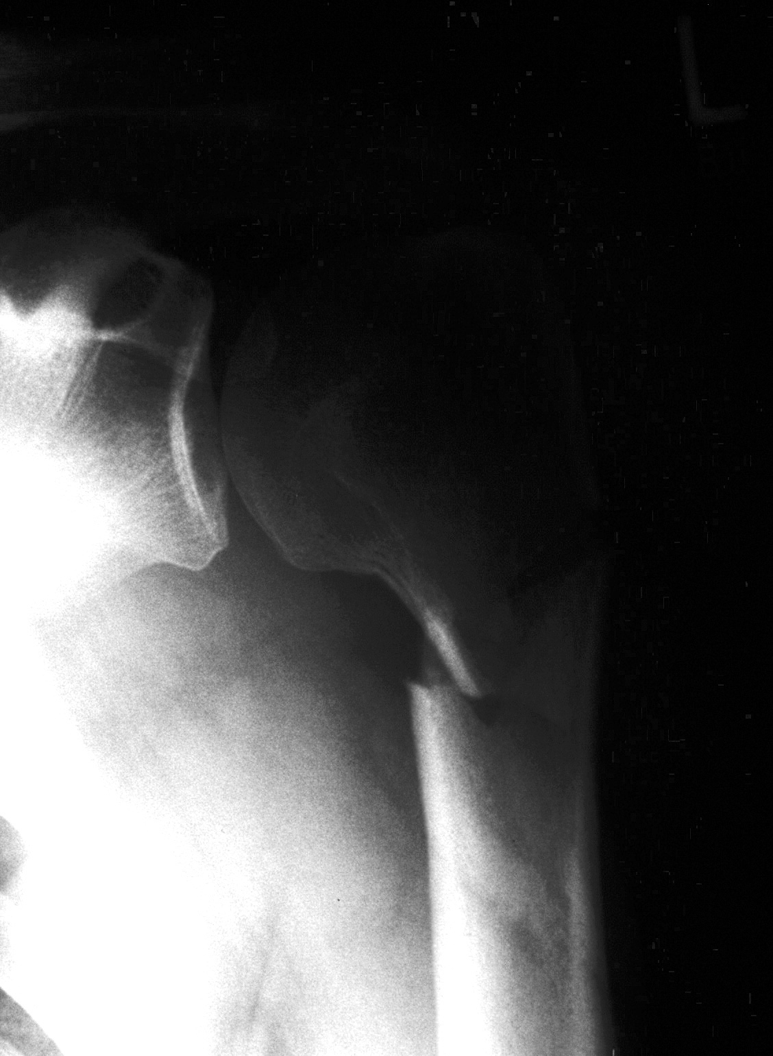 Shoulder X-ray showing a displaced proximal humerus fracture