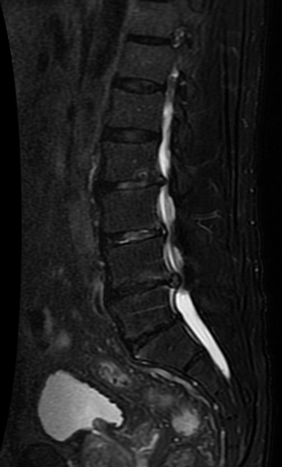 Sagittal and axial MRI of the lumbar spine showing central canal stenosis