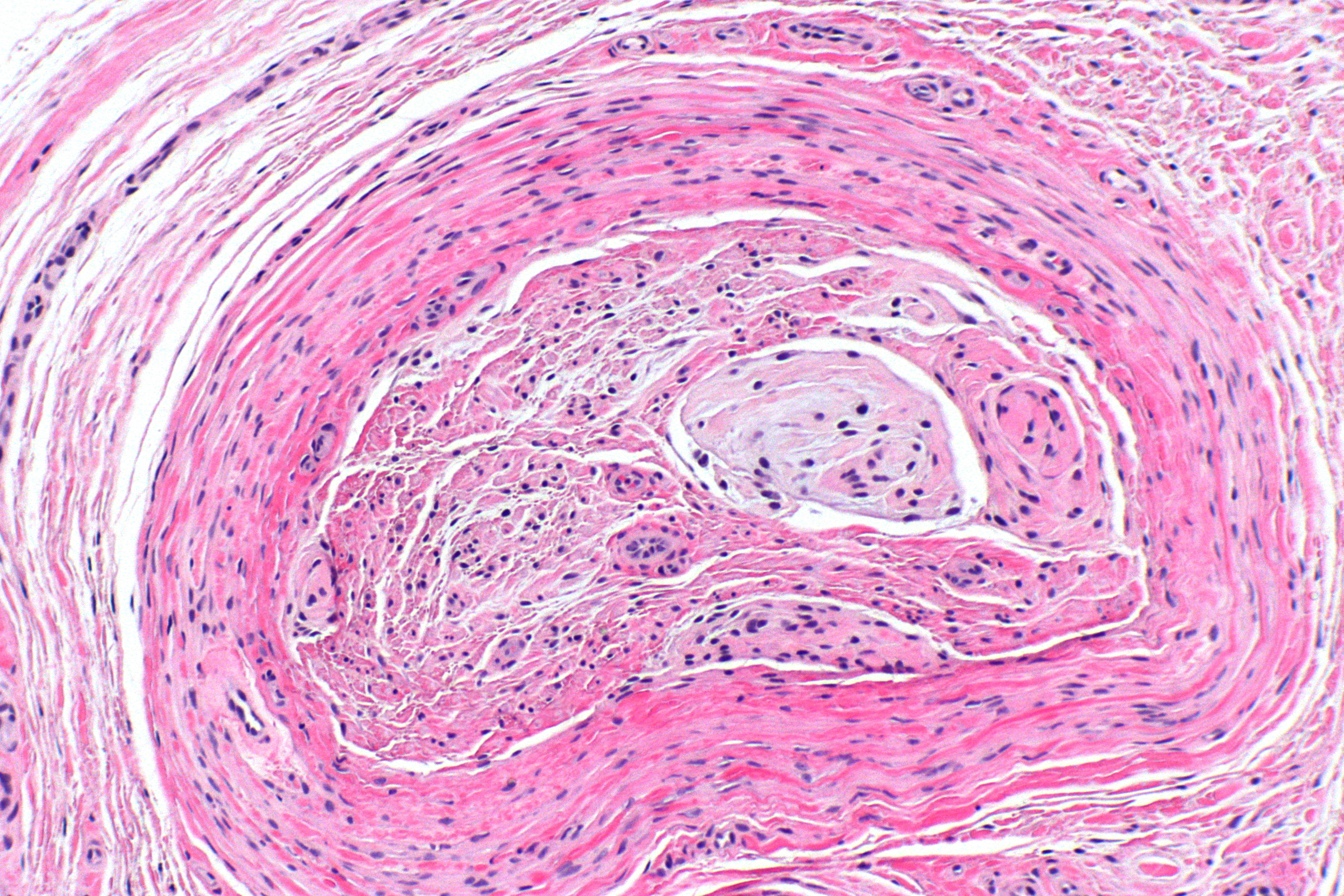 Histology of a Morton interdigital neuroma at intermediate magnification