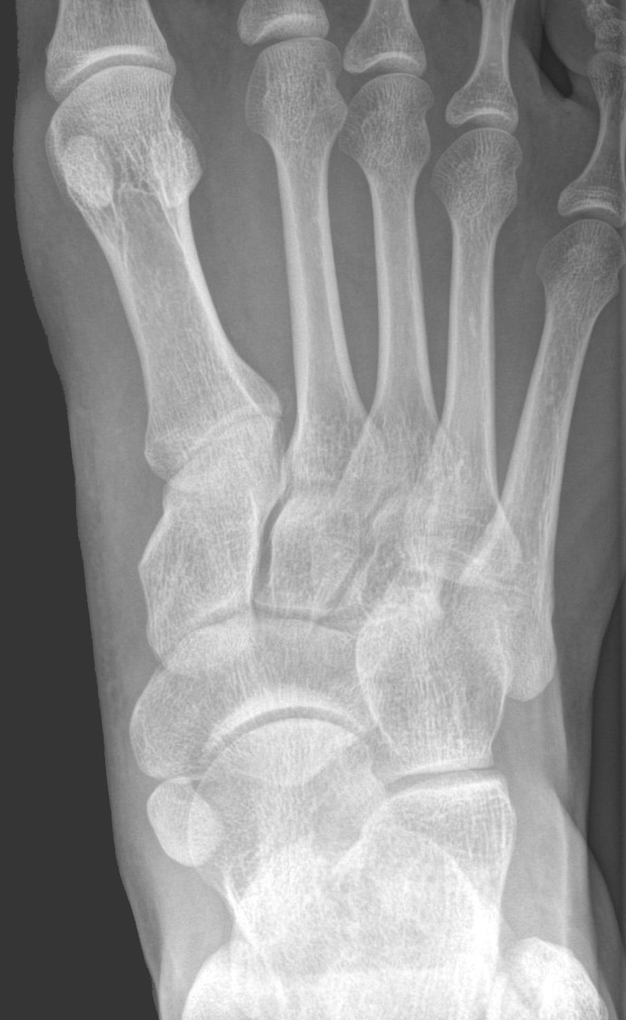 Foot X-ray highlighting the tarsal navicular bone