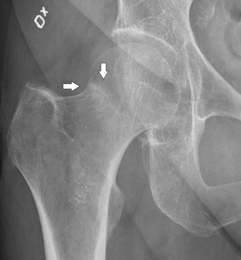 Labeled X-ray showing a subtle compressive femoral-neck fracture