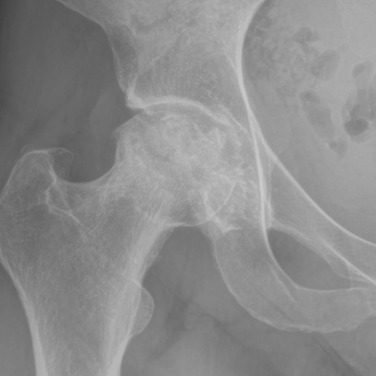 X-ray of a hip with avascular necrosis, showing patchy bright and dark areas in the ball of the joint.