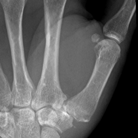 Preoperative PA X-ray zoomed on the thumb CMC joint, joint space narrowing, sclerosis, and dorsal subluxation.