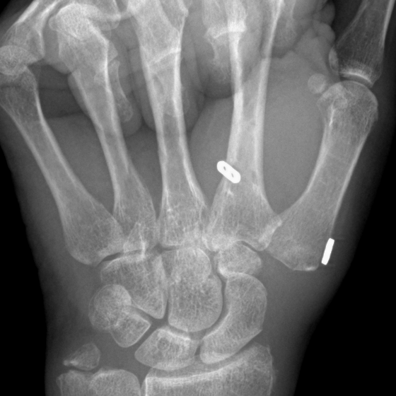 Postoperative X-ray zoomed on the reconstructed thumb base, trapezium removed and a small suture-button implant suspending the thumb metacarpal from the index metacarpal.