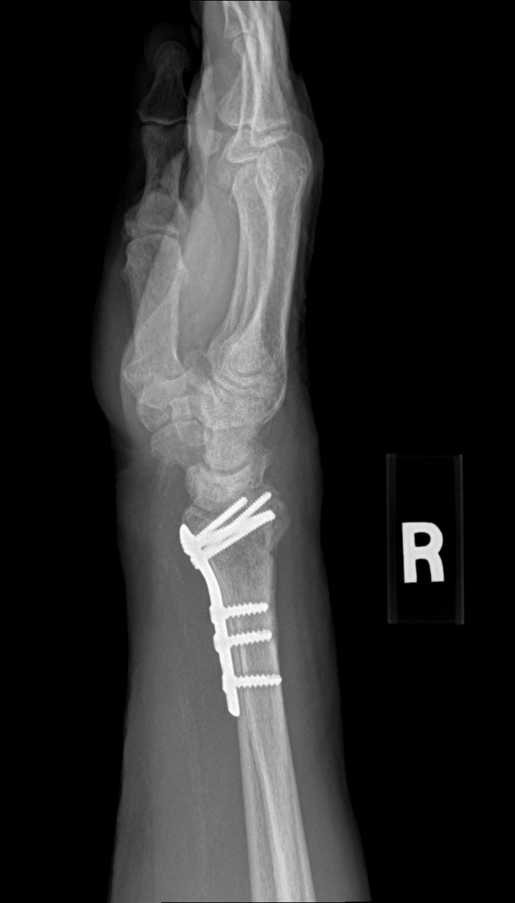 Postoperative lateral X-ray of a right distal radius ORIF with a volar plate