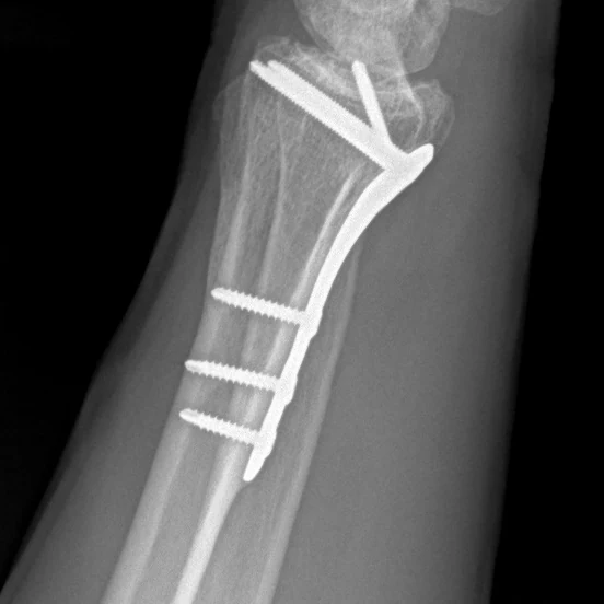 Postoperative lateral X-ray of a right distal radius ORIF with a volar plate and screws restoring length and alignment of the wrist.