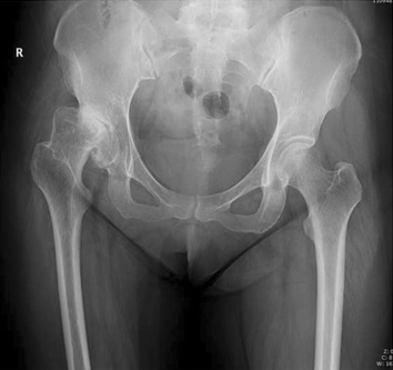 AP pelvis X-ray showing hip arthritis with superolateral joint-space narrowing