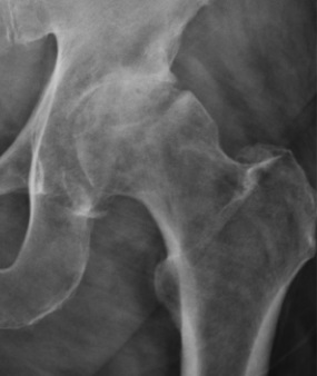 AP pelvis X-ray showing hip osteoarthritis with joint-space narrowing and osteophytes