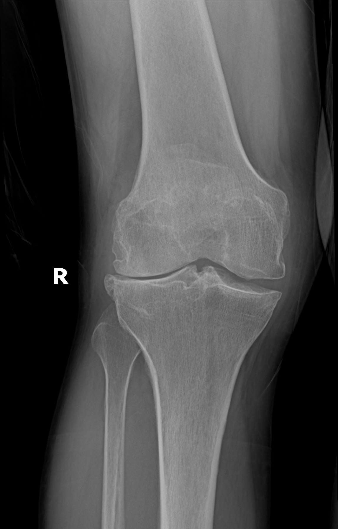AP X-ray of a right knee with medial joint-space narrowing from osteoarthritis