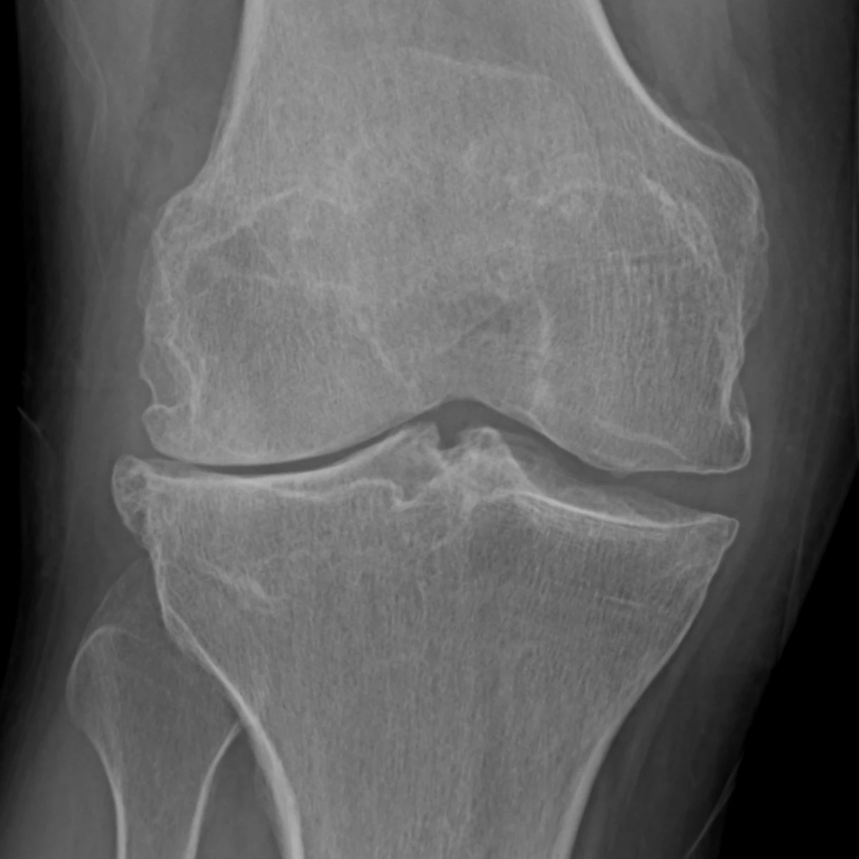 Standing X-ray of a right knee with lateral joint-space narrowing, bone spurs, and sclerosis consistent with valgus-pattern osteoarthritis.