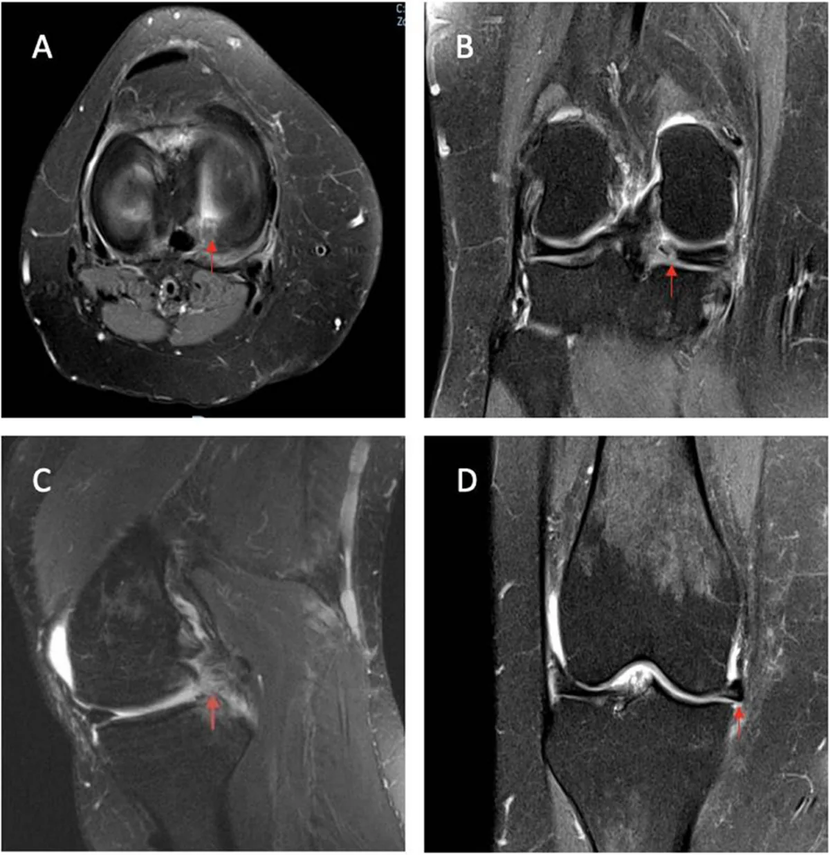 Four-panel MRI montage showing a meniscus root tear across axial, coronal, and sagittal sequences. Red arrows mark the torn root attachment in each view.