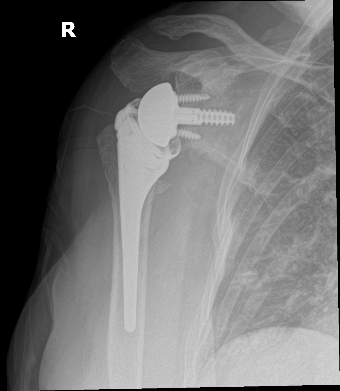 Postoperative AP X-ray of a right reverse total shoulder arthroplasty
