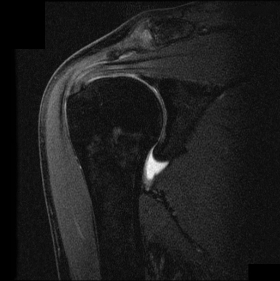 Shoulder MRI showing a full-thickness tear of the supraspinatus tendon
