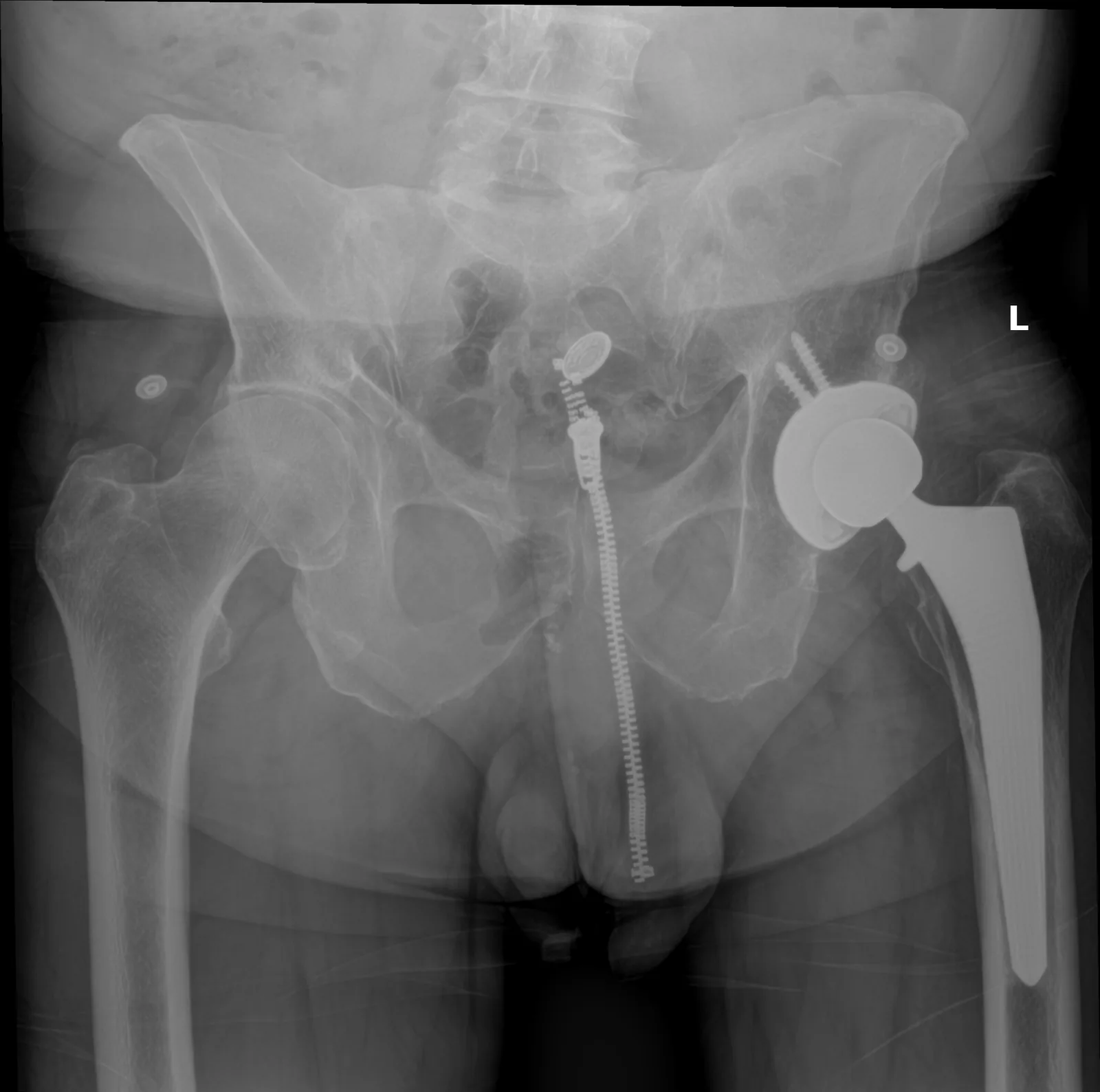 Postoperative AP pelvis X-ray of a total hip replacement with a metal acetabular cup and femoral stem.