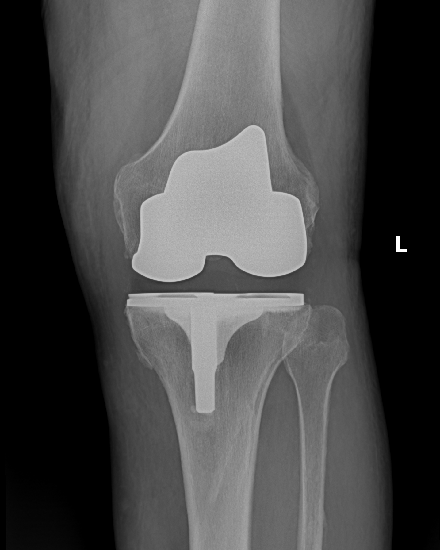 Postoperative AP X-ray of a left total knee replacement with femoral and tibial components