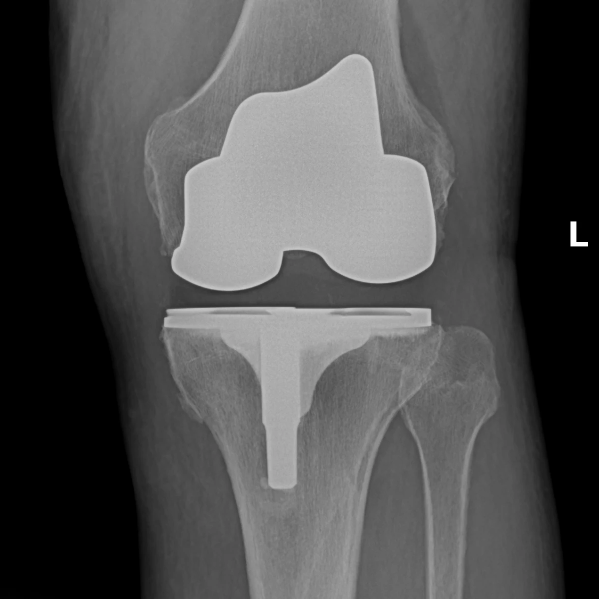 Postoperative AP X-ray of a left total knee replacement showing a well-aligned femoral and tibial component with a polyethylene spacer between them.
