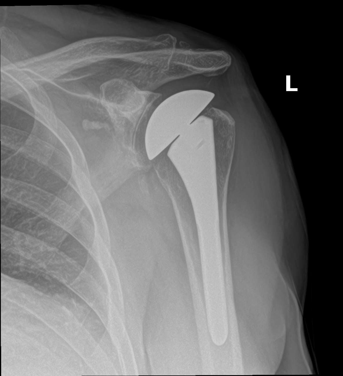 Postoperative X-ray of an anatomic total shoulder replacement showing a polished metal ball on a stem in the upper arm bone and a polyethylene-resurfaced socket on the shoulder blade.